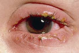 smartphonestodetecteyediseases